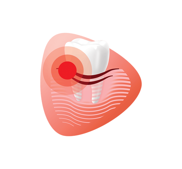 Ilustrácia zubu s červenou bodkou označujúcou bolesť alebo problém