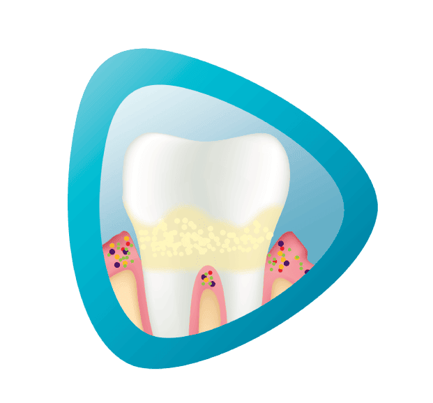 Ilustrácia zuba obklopeného ďasnami s viditeľnými baktériami.
